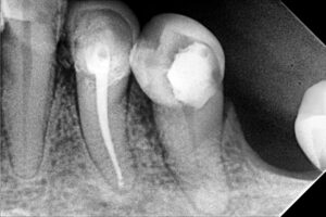 Endodoncia
