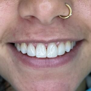 diseño de sonrisa DESPUES