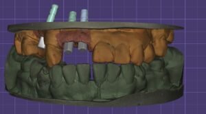 implantes (1)