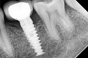 implantes (2)