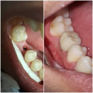 implantes
