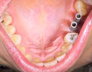 implantes